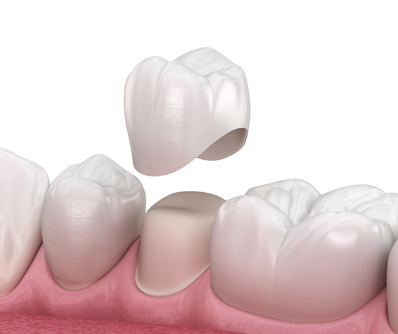 A dental crown on a model tooth, showing the crown covering the visible part of the tooth