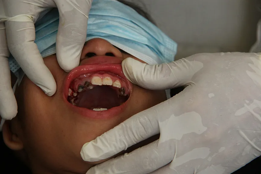 Dental Emergency? What to Do in the First Hour