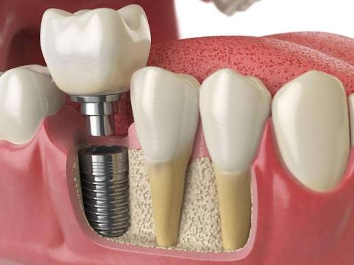 Illustration showing an implant post in the jawbone, an abutment connector and a crown above the gumline