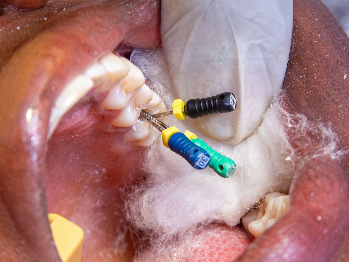 Root Canal Treatment: Myths vs. Reality