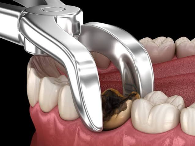 The Complete Guide to Tooth Extraction