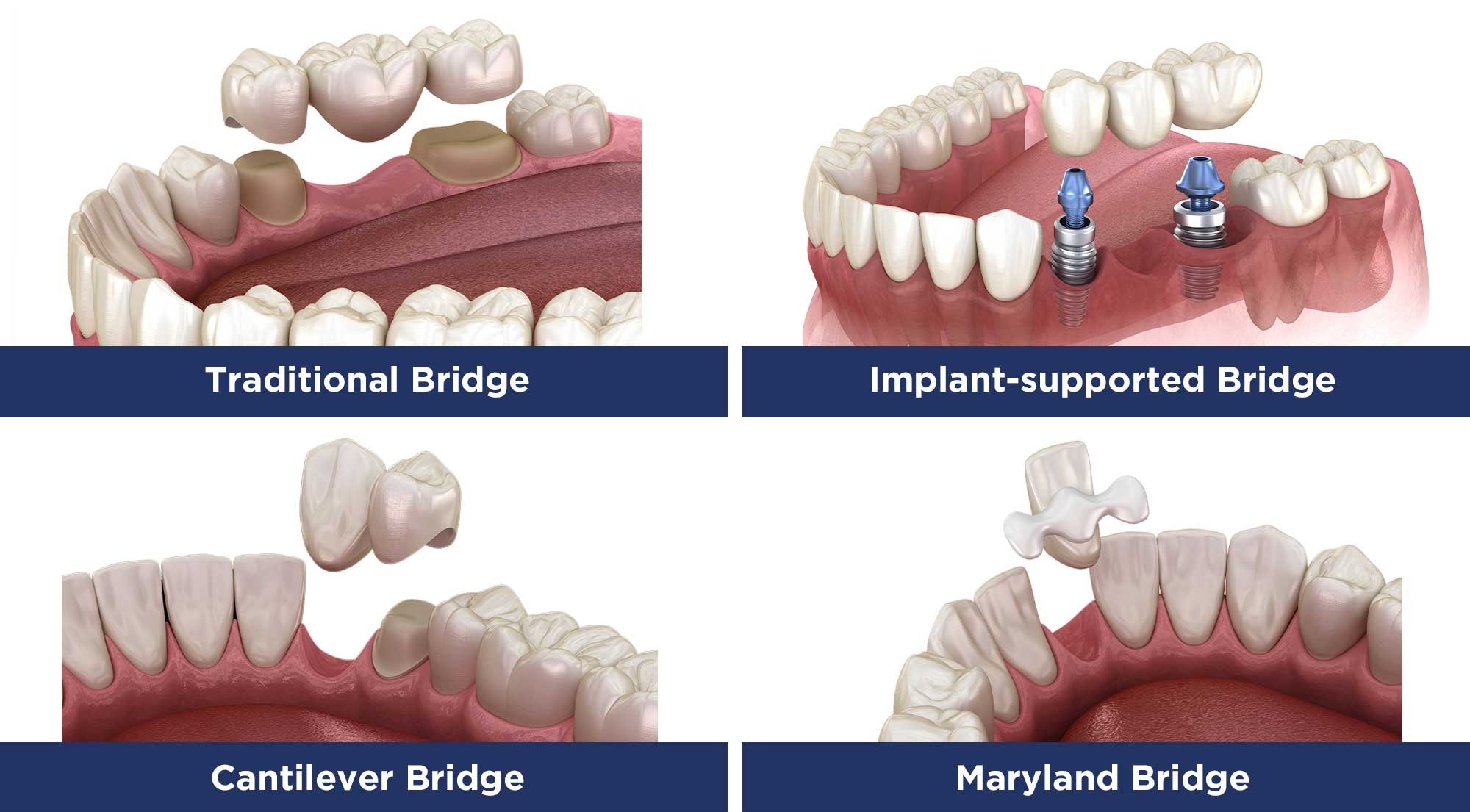  Four types of dental bridges: conventional, cantilever, resin-bonded and implant-supported
