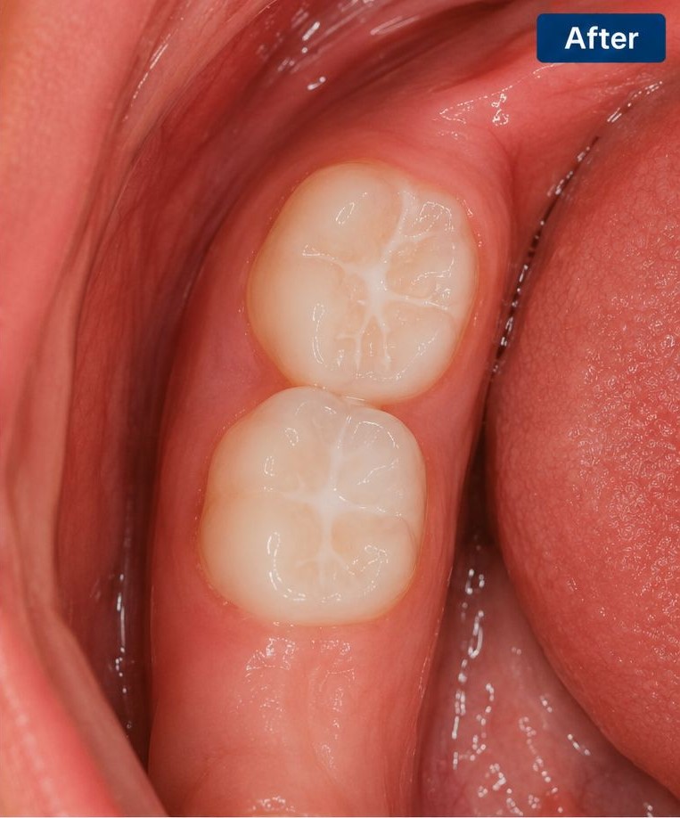 Dental Sealants