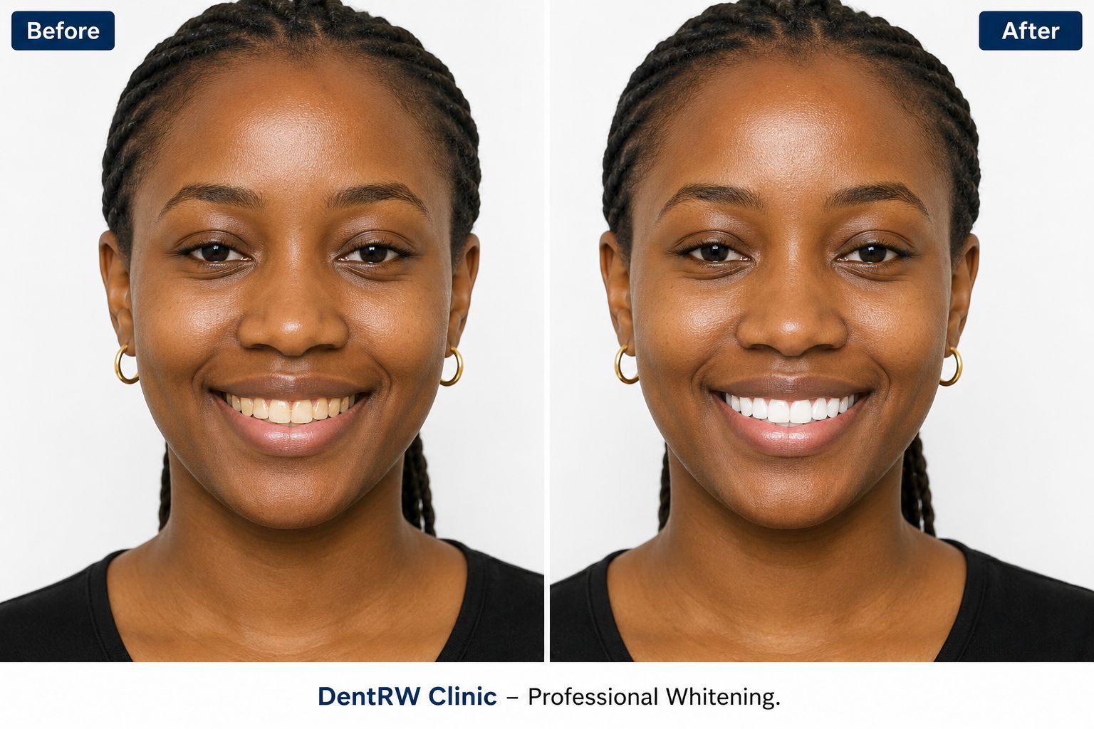 Side-by-side smile before and after professional whitening, with visibly lighter teeth in the after photo